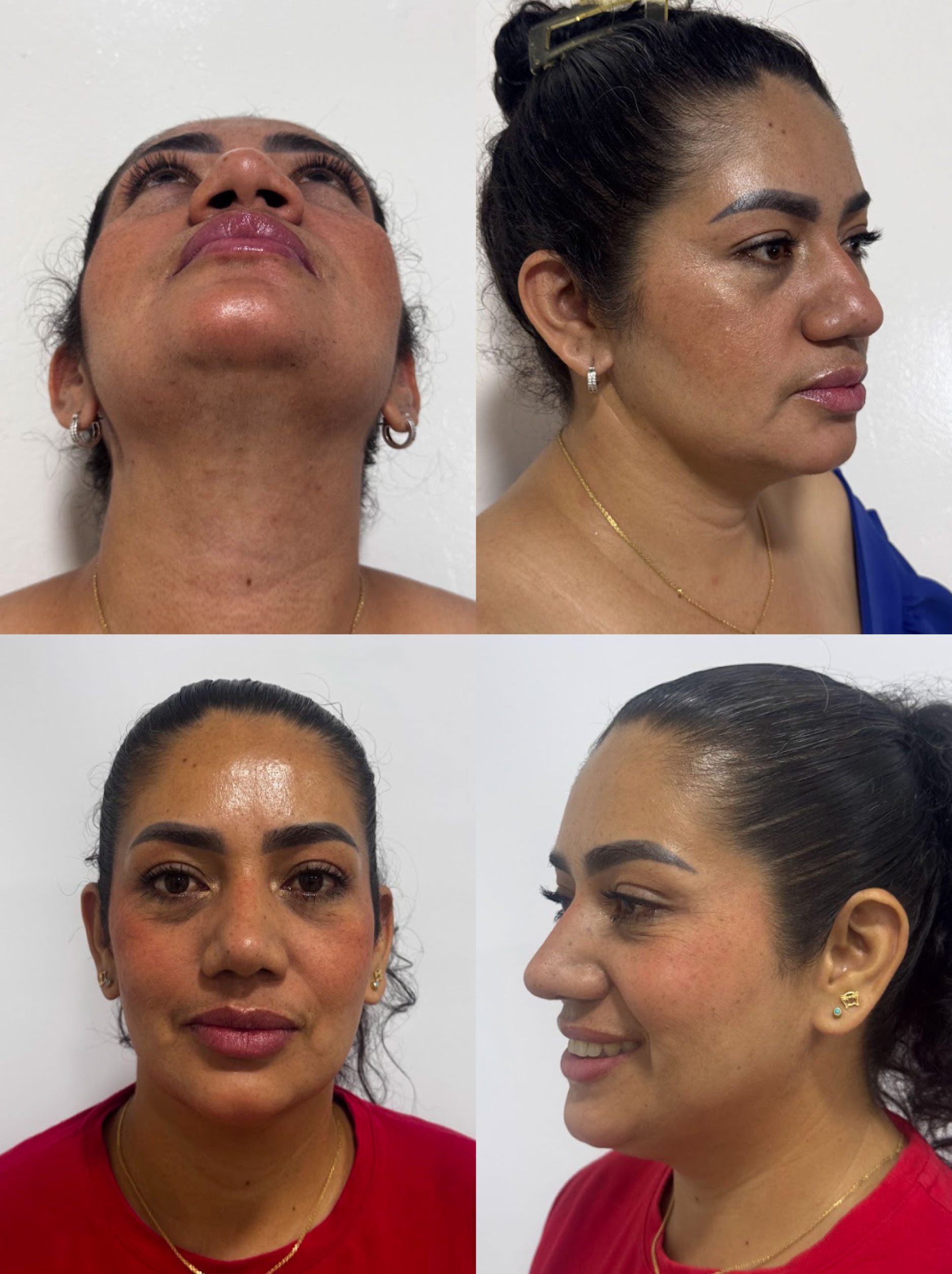 Rinoplastia caso 4