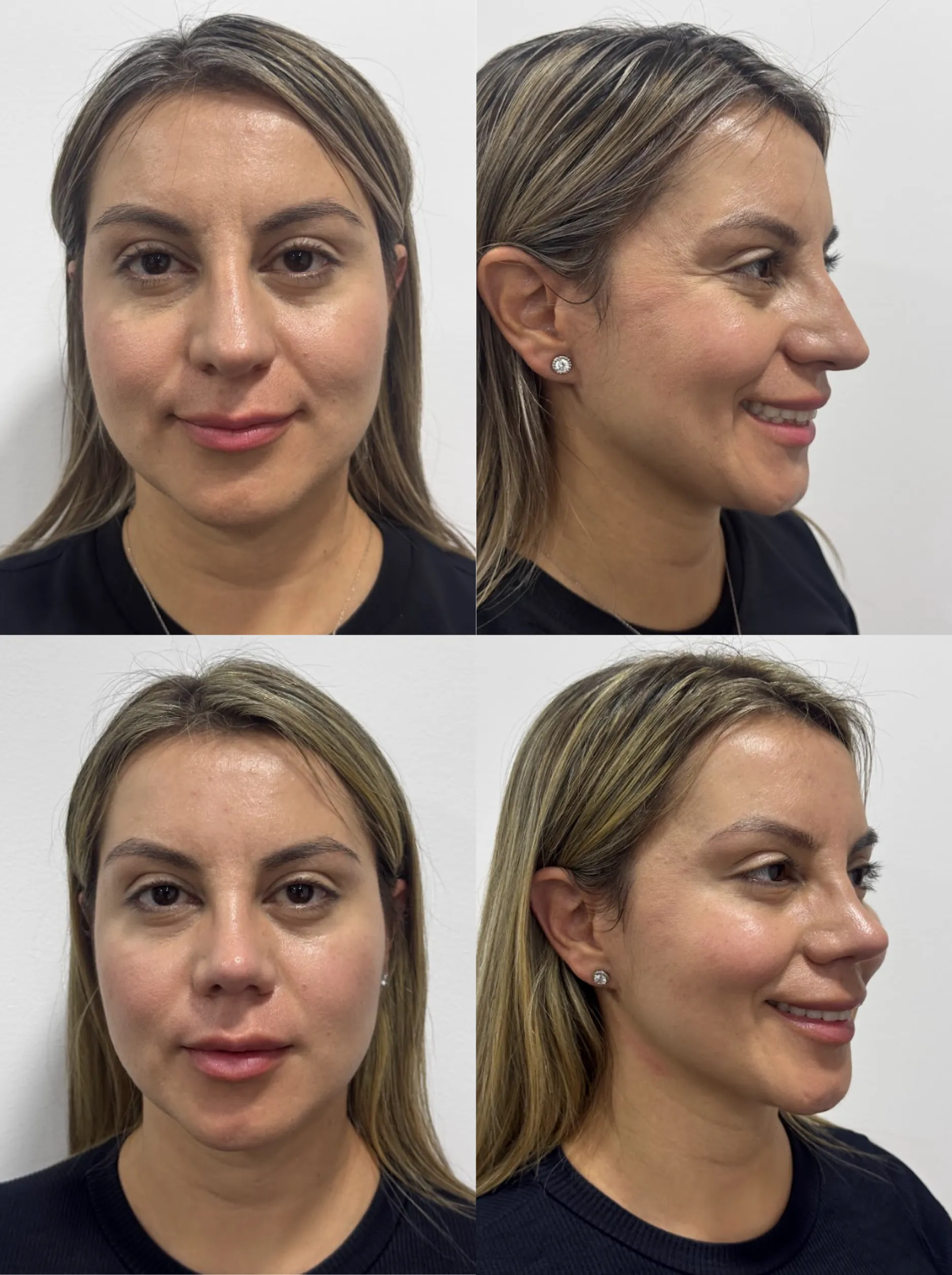 Rinoplastia caso 5